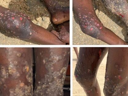 Scabies-outbreak-in-Gambian-Quranic-school