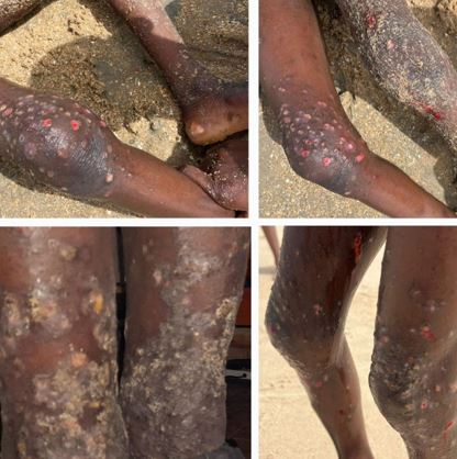 Scabies-outbreak-in-Gambian-Quranic-school